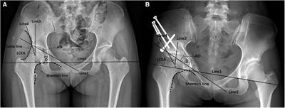 Construction of a predictive nomogram for functional recovery after Bernese periacetabular osteotomy